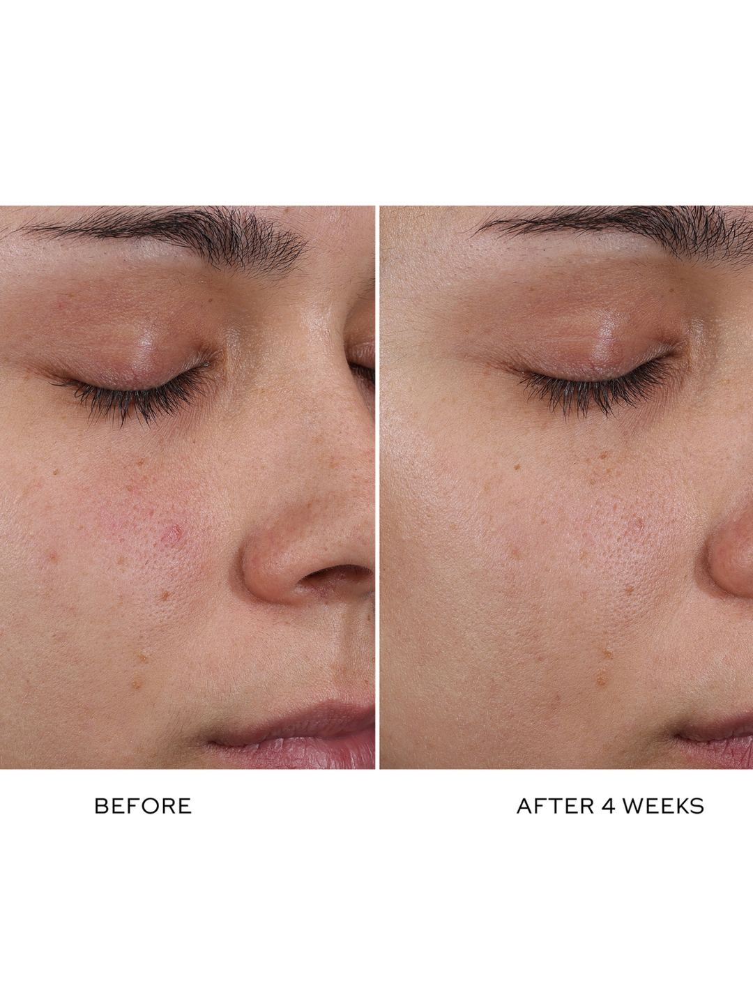 Before and after comparison of a person's face with acne, showing improvement over 4 weeks.
