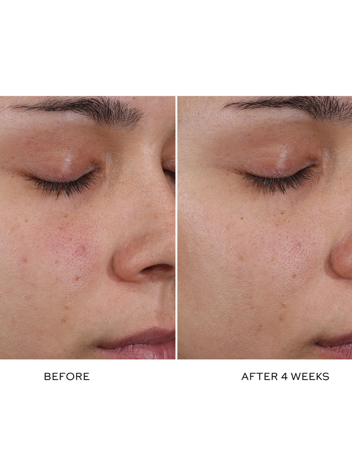 Before and after comparison of a person's face with acne, showing improvement over 4 weeks.